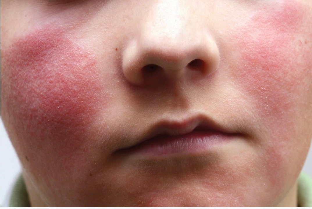 A Visual Guide to Viral Rashes – Stories Waves