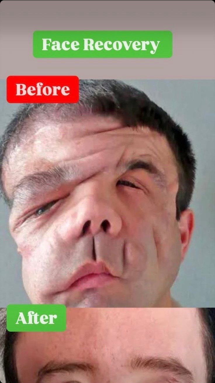 ST, The First Person In The World To Have Two Full Face Transplants Is a Frenchman